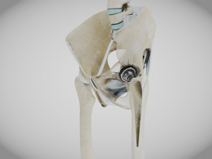 Replaced Hip Implant Modelo 3D
