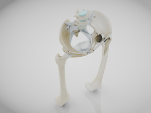 Replaced Hip Implant Modelo 3D
