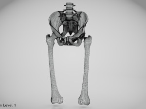 Replaced Hip Implant Modelo 3D