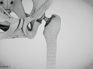 Replaced Hip Implant Modelo 3D