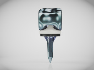 Knee Implant 3D मॉडल