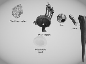 Pelvic Implant Modelo 3D