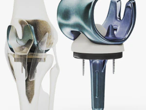 Knieersatzimplantat 3D Modell