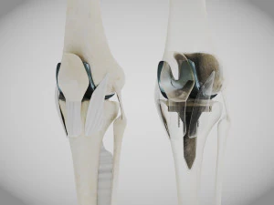 Impianto di sostituzione del ginocchio Modello 3D