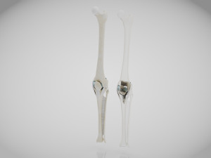 Knee Replacement Implant 3D 模型