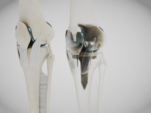 Knee Replacement Implant 3D 模型