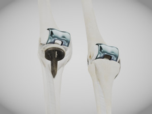 Knee Replacement Implant 3D 模型