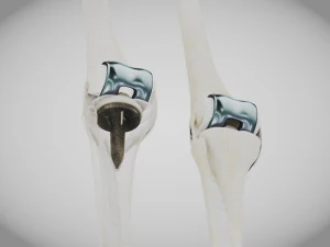 Impianto di sostituzione del ginocchio Modello 3D