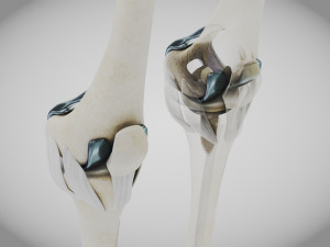 Knee Replacement Implant 3D 模型
