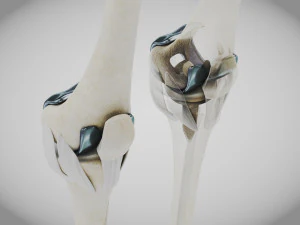 Impianto di sostituzione del ginocchio Modello 3D