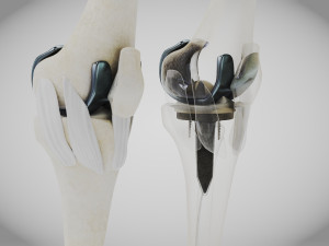 Knee Replacement Implant 3D 模型