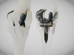 Impianto di sostituzione del ginocchio Modello 3D
