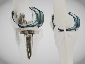 Knee Replacement Implant 3D 模型
