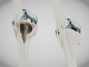 Knee Replacement Implant 3D 模型