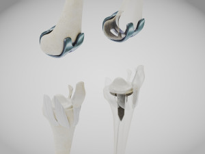 Knee Replacement Implant 3D 模型