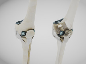 Knee Replacement Implant 3D 模型