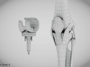 Impianto di sostituzione del ginocchio Modello 3D