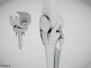 Impianto di sostituzione del ginocchio Modello 3D
