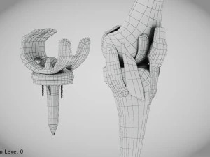 Impianto di sostituzione del ginocchio Modello 3D