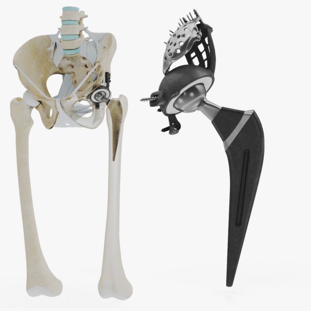 Pelvic Replacement Implant 3D Model .c4d .max .obj .3ds .fbx .stl .blend 