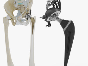Pelvic Replacement Implant Modello 3D