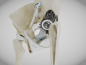 Pelvic Replacement Implant 3D Model