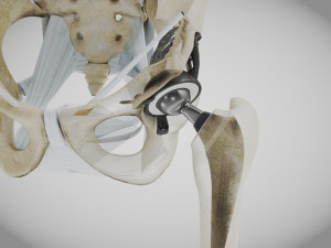 Pelvic Replacement Implant 3D Model