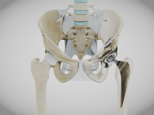 Pelvic Replacement Implant 3D Model