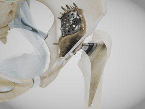 Pelvic Replacement Implant 3D Model