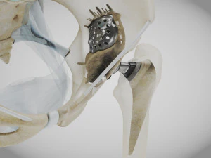 Pelvic Replacement Implant 3D Model