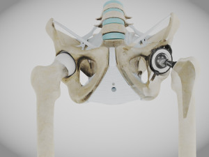 Pelvic Replacement Implant 3D Model