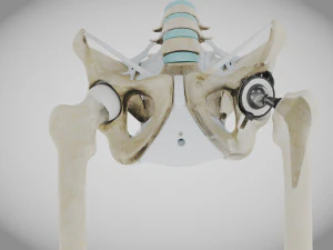 Pelvic Replacement Implant 3D Model