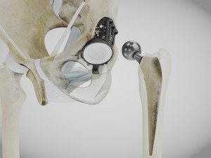 Pelvic Replacement Implant 3D Model