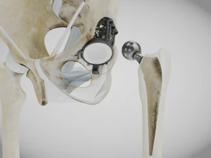 Pelvic Replacement Implant 3D Model
