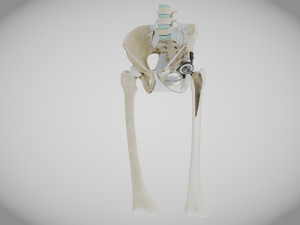 Pelvic Replacement Implant 3D Model