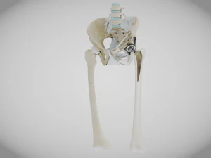 Pelvic Replacement Implant 3D Model
