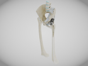 Pelvic Replacement Implant 3D Model