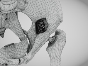 Pelvic Replacement Implant 3D Model