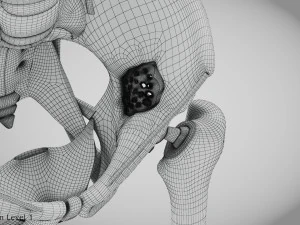 Pelvic Replacement Implant 3D Model
