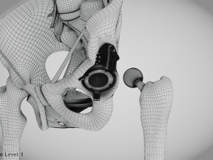 Pelvic Replacement Implant 3D Model