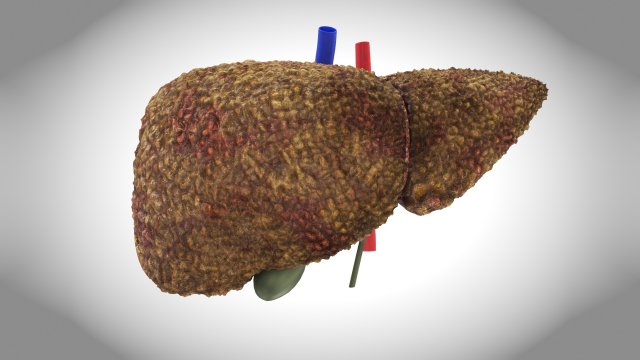 Cirrhosis Liver Disease 3D 모델 .c4d .max .obj .3ds .fbx .stl .blend 