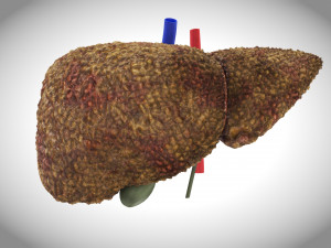 Cirrhosis Liver Disease 3D 模型
