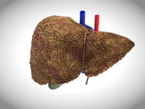 Cirrhosis Liver Disease 3D 모델