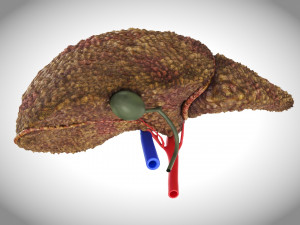 Cirrhosis Liver Disease 3D 모델