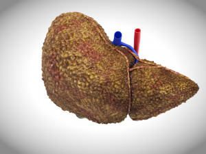 Cirrhosis Liver Disease 3D 모델