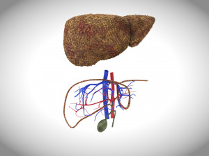 Cirrhosis Liver Disease 3D 모델
