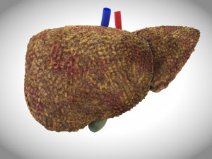Cirrhosis Liver Disease 3D 모델