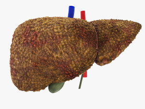 Cirrhosis Liver Disease 3D 모델