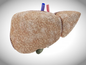 Fibrosis Liver Disease 3D 모델