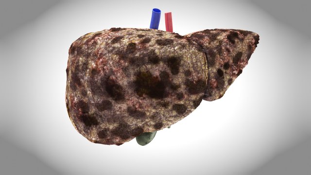 Hepatocellular Carcinoma Liver Modelo 3D .c4d .max .obj .3ds .fbx .stl .blend 